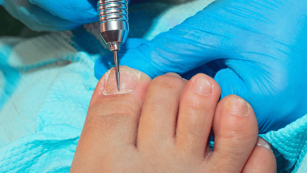 How is the Development of Nails Related to Overall Hand Surgery