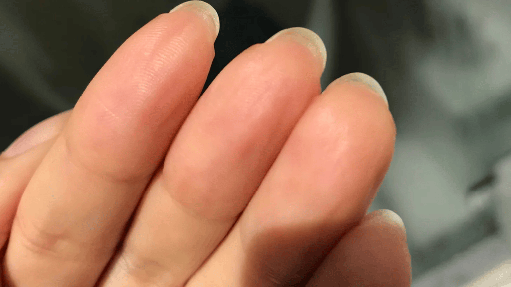 Hyponychium and Nail Bed