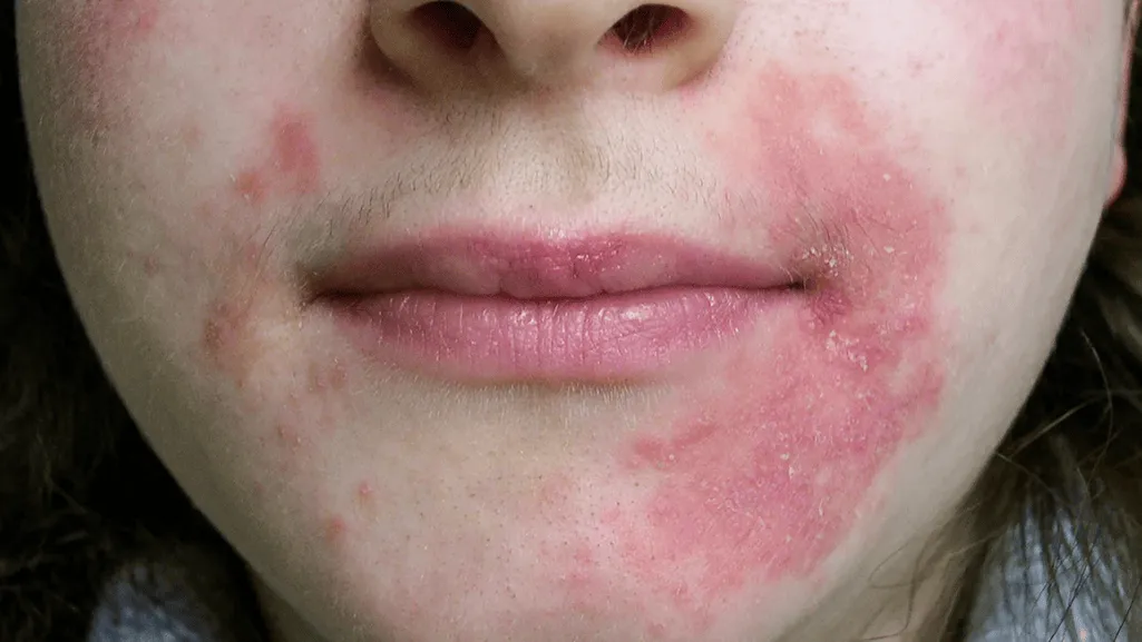 allergic reaction bumps on lips