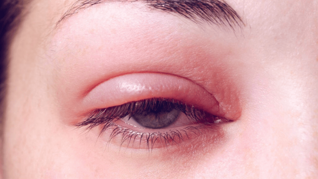 blepharitis eye makeup
