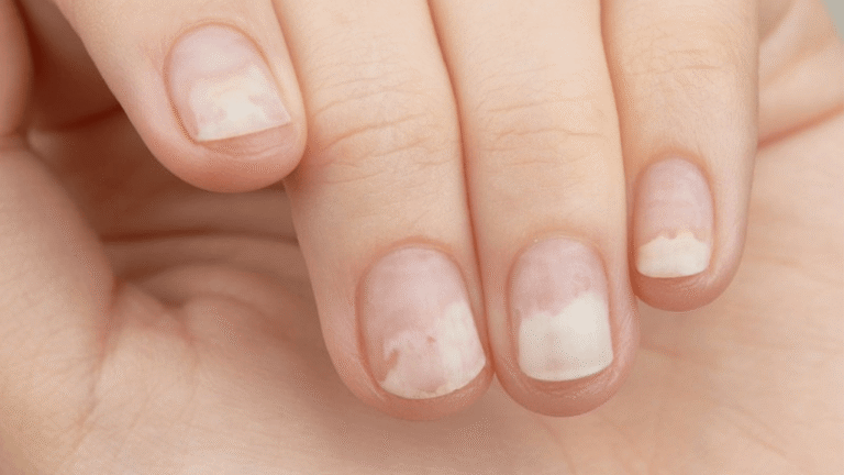 Nail Disorders