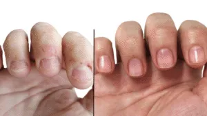 Nail Transformation
