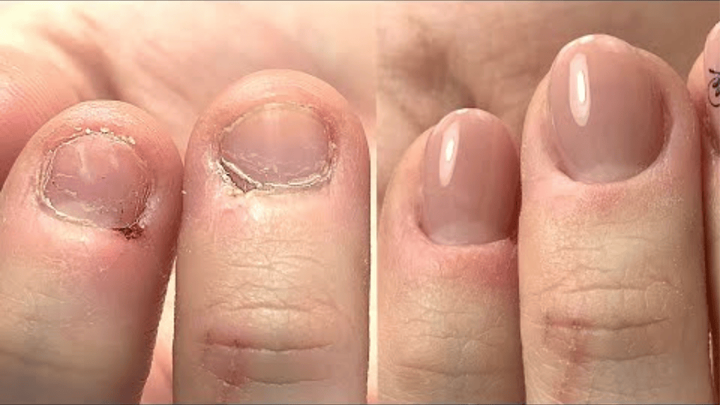 Nail Transformation