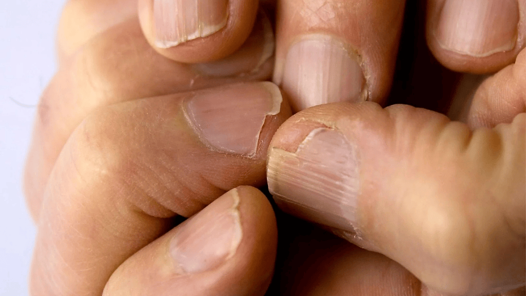 brittle nails
