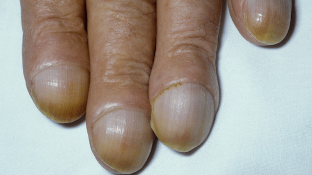 nail disorders