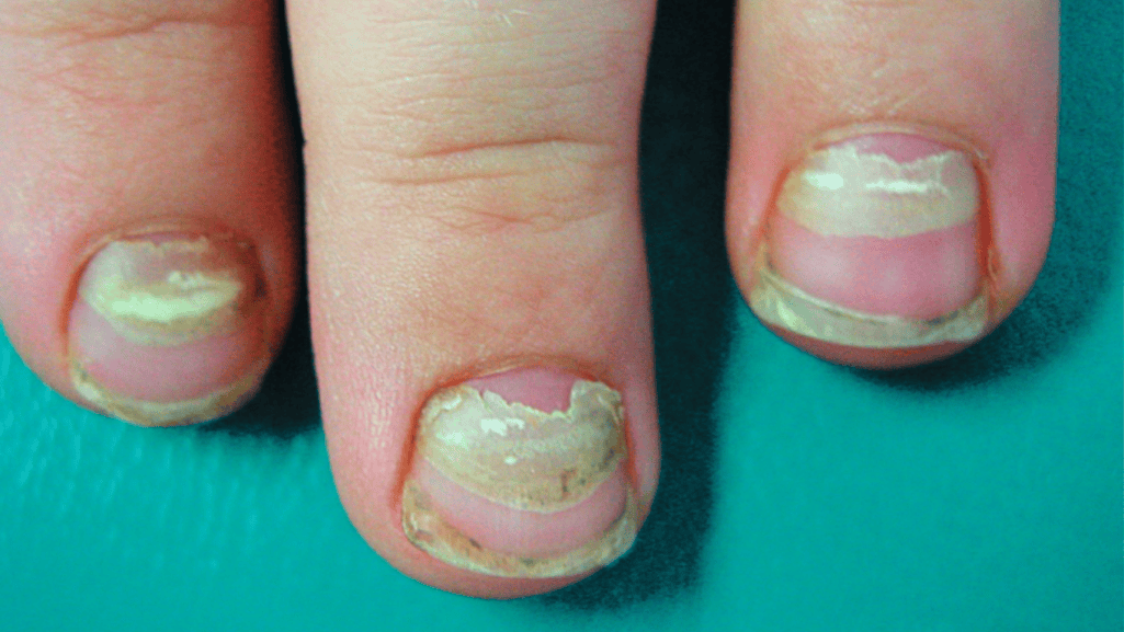 systemic nail signs