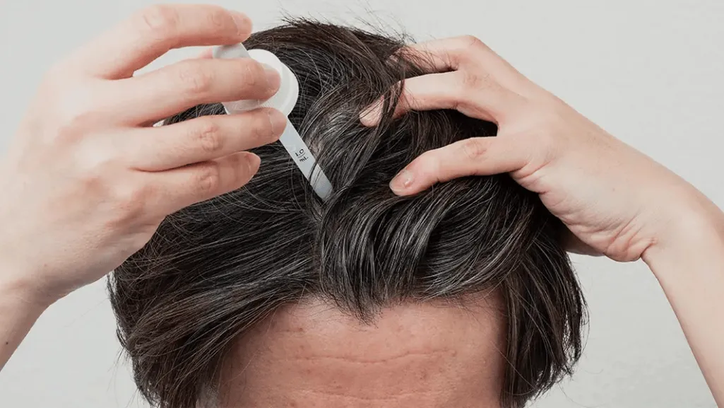 minoxidil scalp minoxidil scalp