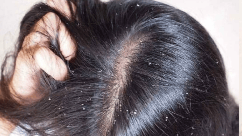 severe scalp dandruff treatment
