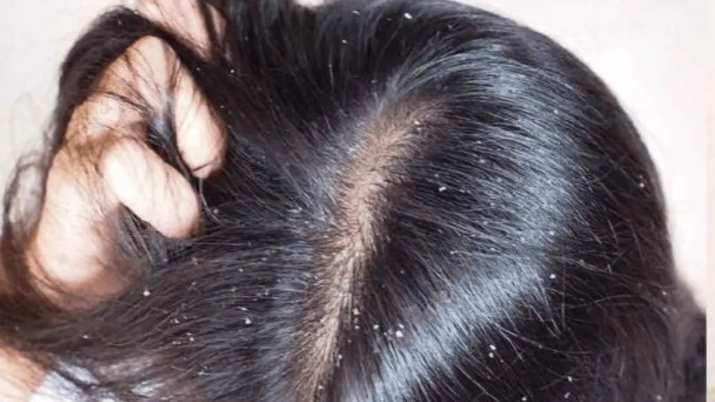 severe scalp dandruff treatment severe scalp dandruff treatment